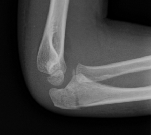 Figure 2_combined olecranon fracture lateral.jpg